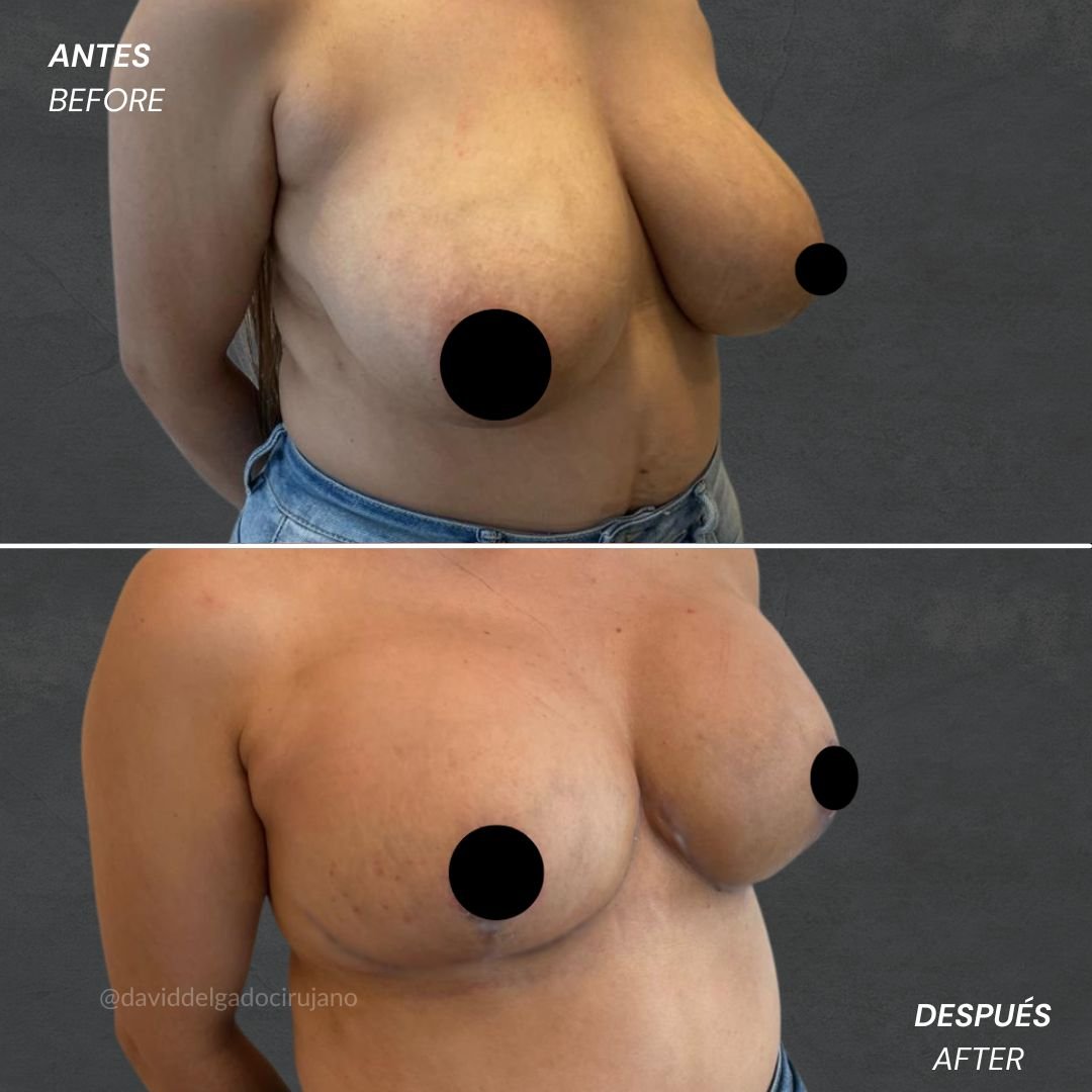 Before and After Mastopexy David Delgado Plastic Surgery in Medellín