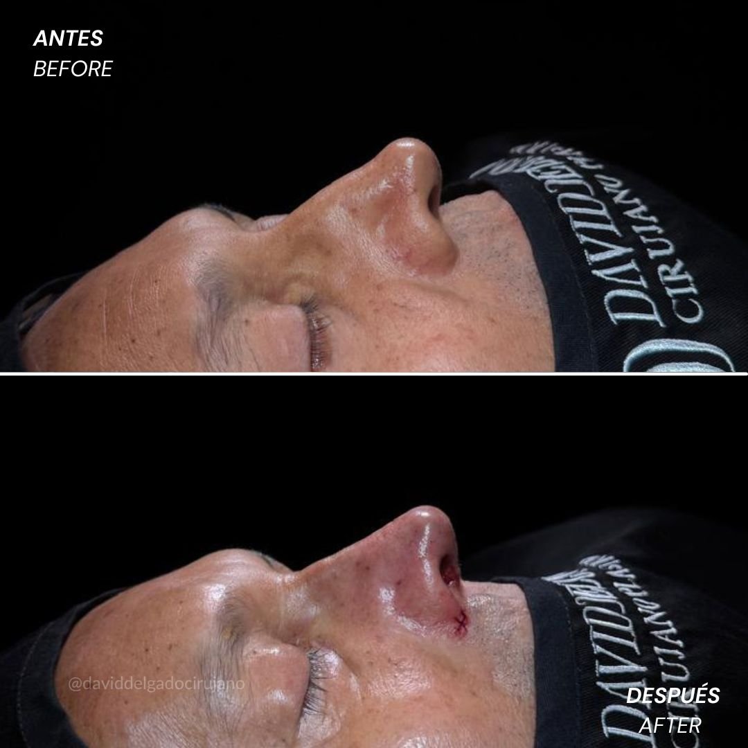 Before and After Rhinoplasty David Delgado Plastic Surgery in Medellín