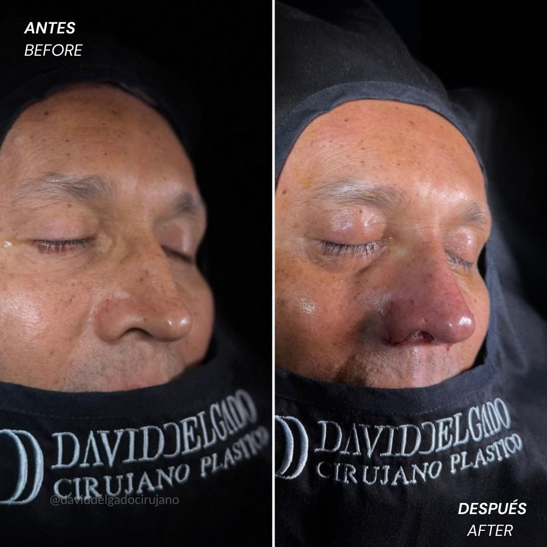 Before and After Rhinoplasty David Delgado Plastic Surgery in Medellín