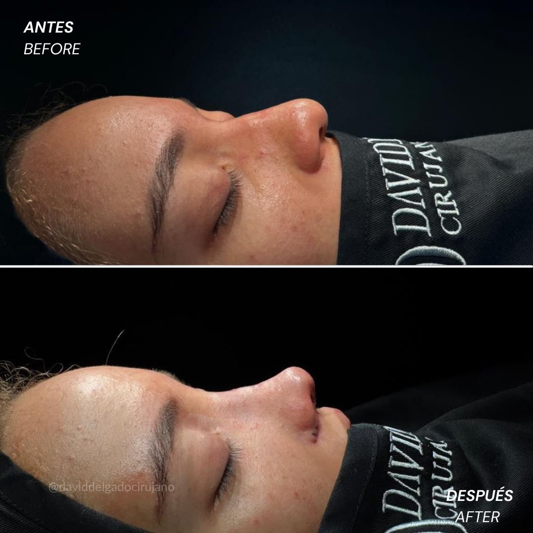 Before and After Ultrasonic Rhinoplasty David Delgado Plastic Surgery in Medellín