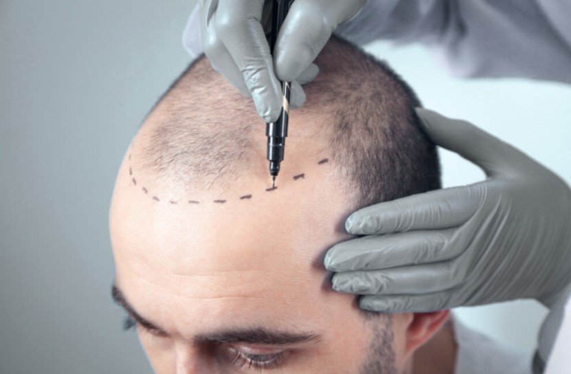 Hair trasplant in Colombia - Be Dharma aesthetic clinic in Medellín - plastic surgeon David Delgado