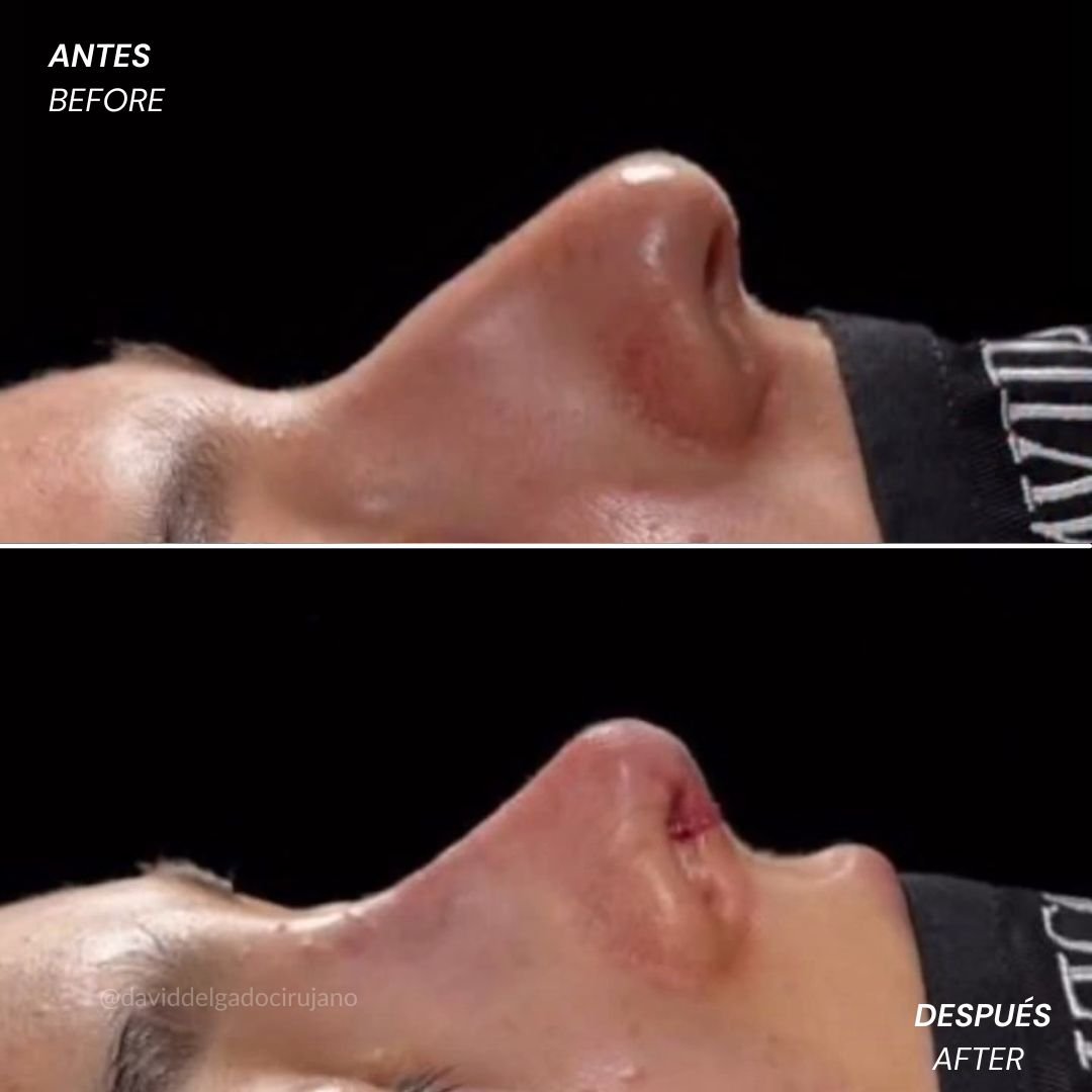 Before and After Ultrasonic Rhinoplasty David Delgado Plastic Surgery in Medellín