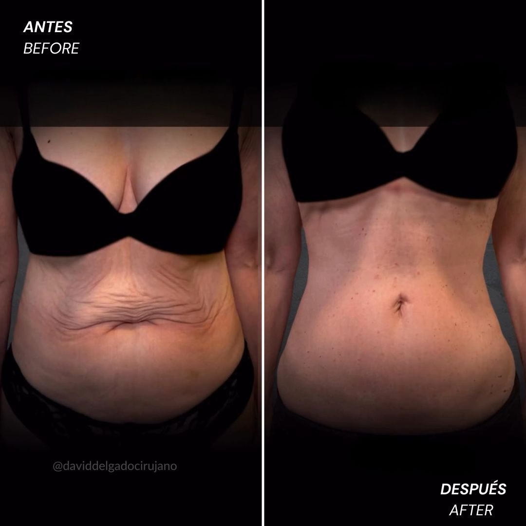Tummy tuck before and after case 1 — Dr. David Delgado, Colombia