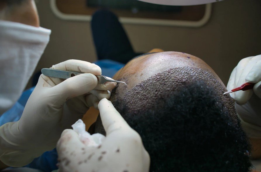 Dr. David Delgado performing a hair transplant in Colombia and discussing the price - Be Dharma Hair