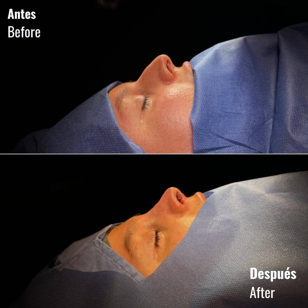 Before and after ultrasonic rhinoplasty - Dr. David Delgado