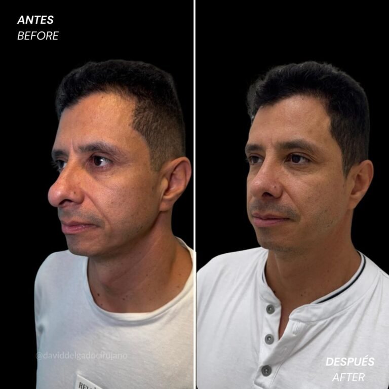 Rhinolplasty before and after David delgado plastic surgeon in colombia - 011025