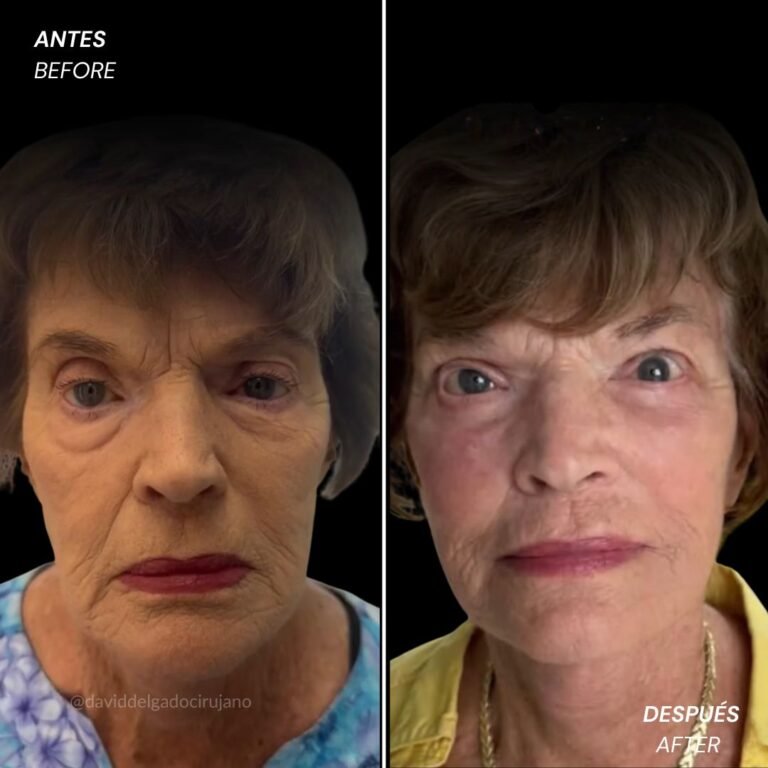 Blepharoplasty and Rhytidoplasty before and after with Medellín plastic surgeon David Delgado - 041125