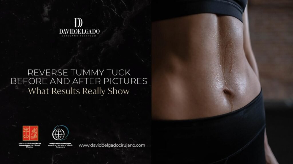Reverse Tummy Tuck Before and After Pictures-Dr. David Delgado