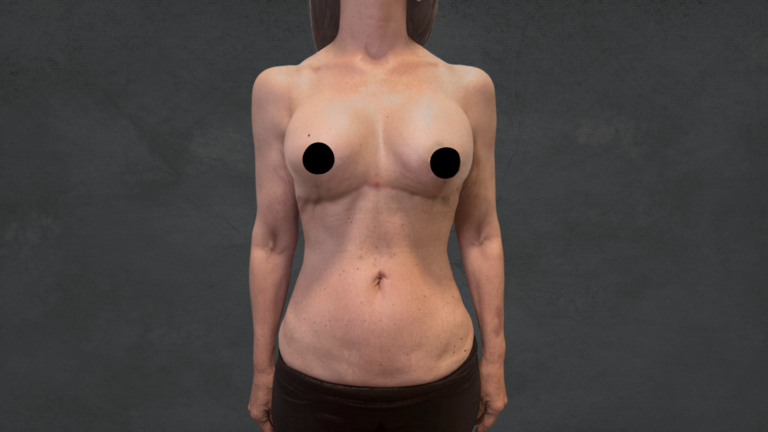 Reverse Tummy Tuck-Dr. David Delgado