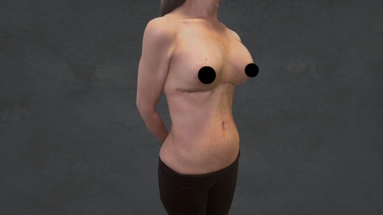 Reverse Tummy Tuck-Dr. David Delgado