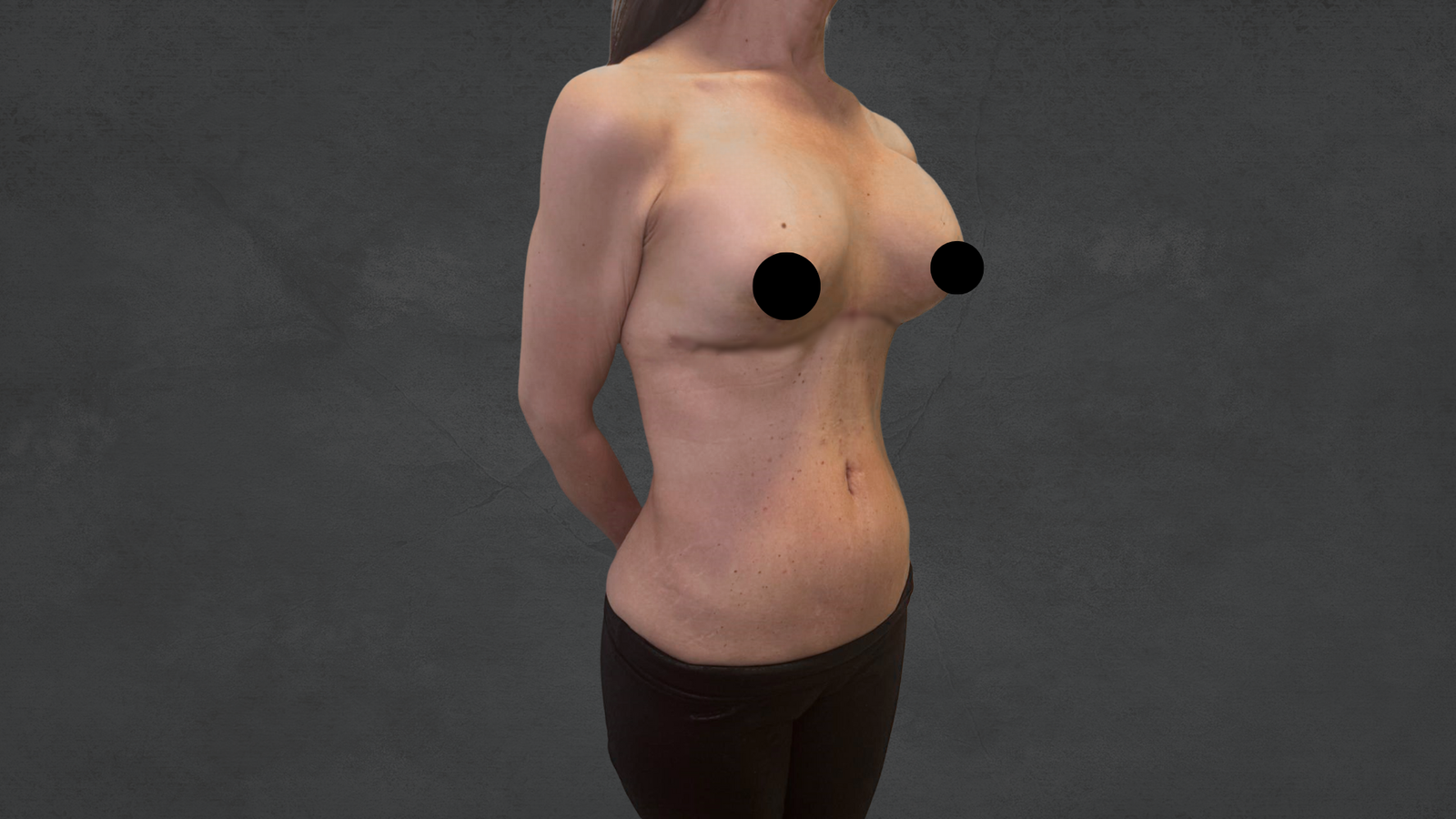 Reverse Tummy Tuck-Dr. David Delgado
