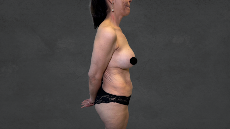 Reverse Tummy Tuck-Dr. David Delgado