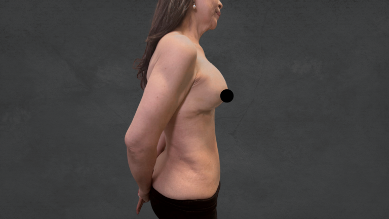 Reverse Tummy Tuck-Dr. David Delgado