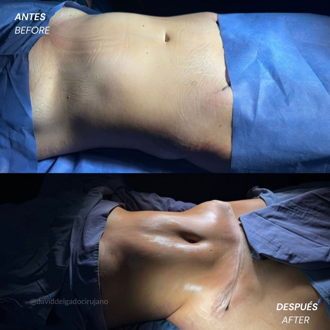 Tummy tuck before and after case 3 — Dr. David Delgado, Colombia