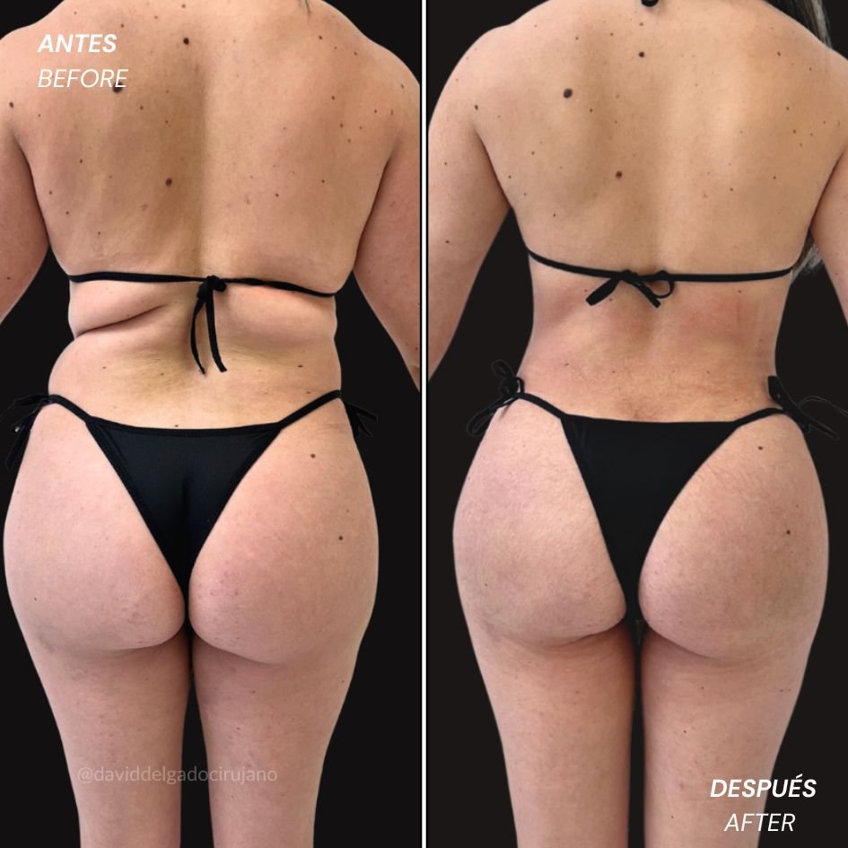 liposuction 360 en Colombia - Caso de Antes y después - Dr. David Delgado Cirujano Plástico Medellín - Plastic Surgery Medellín - Colombia