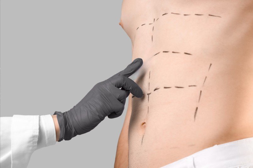 Radiofrequency liposuction- Dr. David Delgado