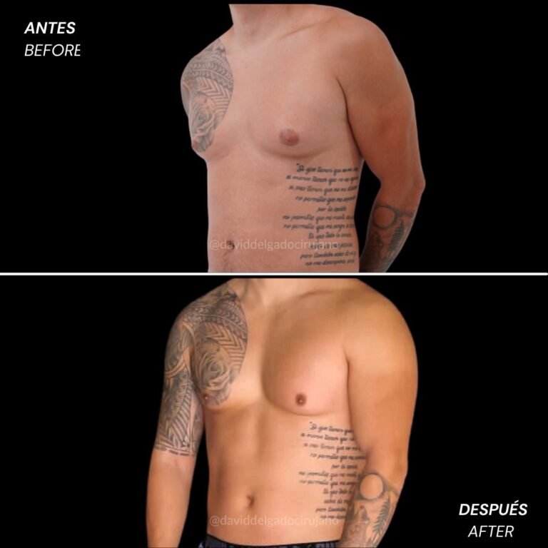 Before and after gynecomastia - Antes y después de una ginecomastia en hombres - Dr. David Delgado Cirujano Plástico en Medellín