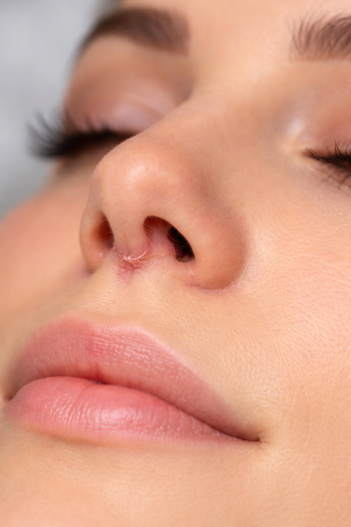 Rhinoplasty Scar-Dr. David Delgado