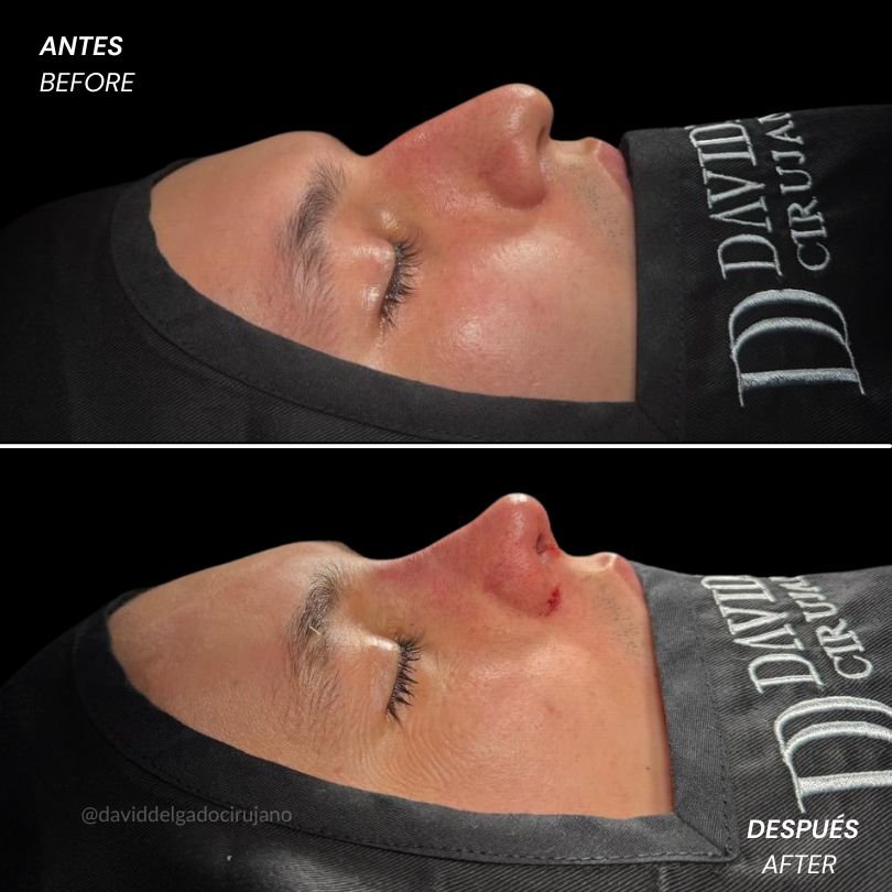 Before and After Rhinoplasty - Rinoplastia ultrasónica en Medellín - Dr. David Delgado - Cirujano Plástico en Medellín