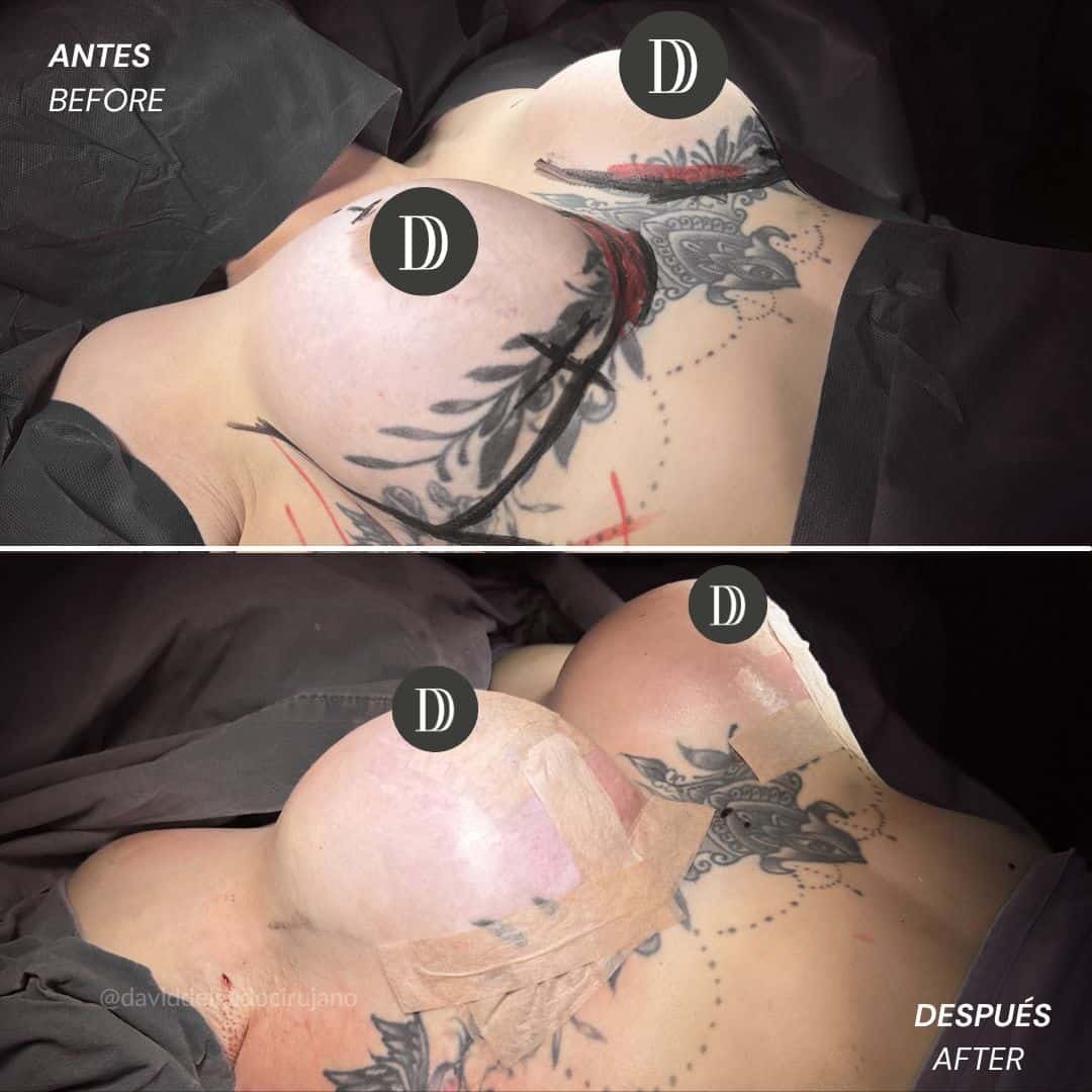 Before and After Mastopexy - Mastopexia con cambio de implantes en Medellín - Dr. David Delgado - Cirujano Plástico en Medellín