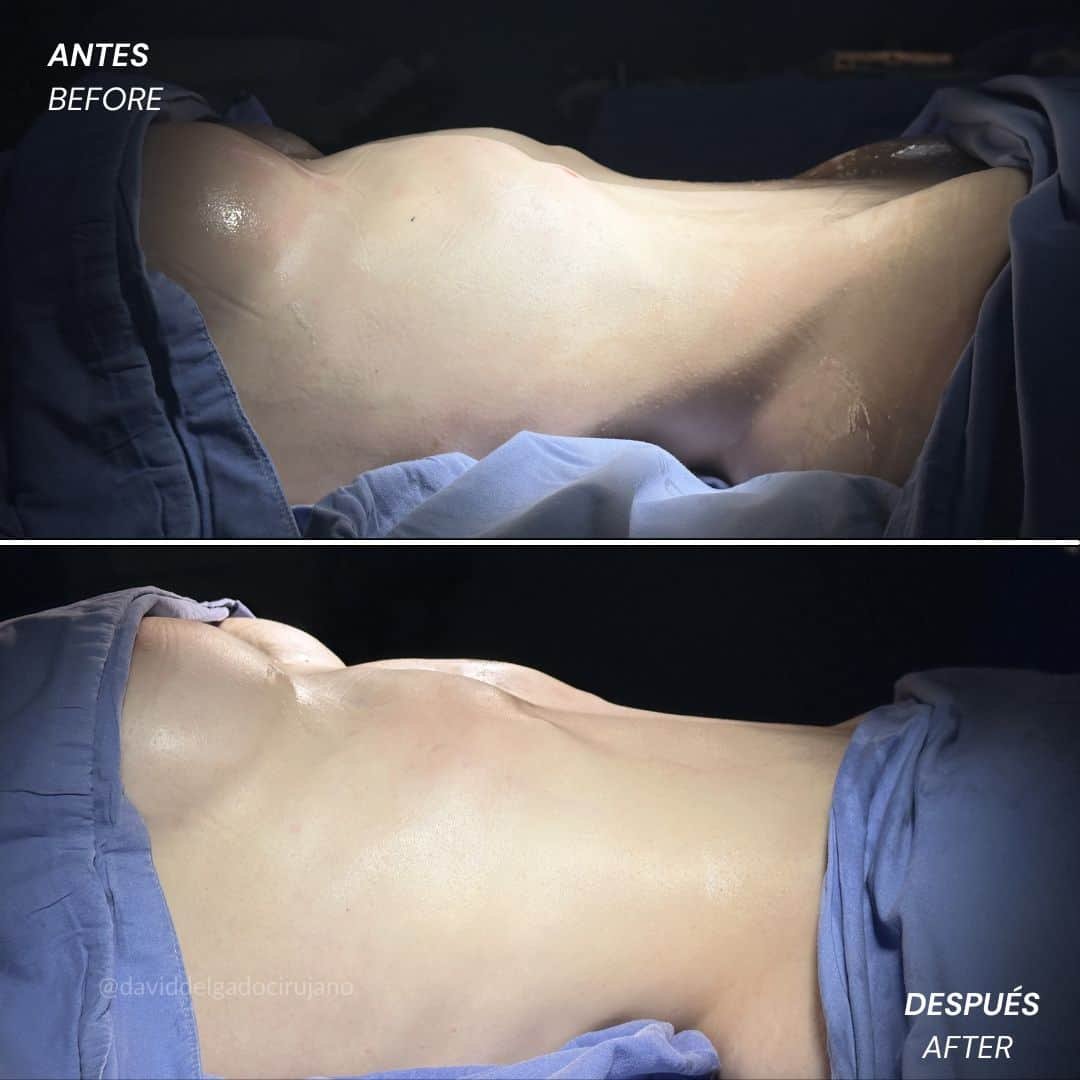 Rib Remodeling - Remodelación Costal en Medellín - Luxación de costillas - Dr. David Delgado - Cirujano Plástico en Medellín