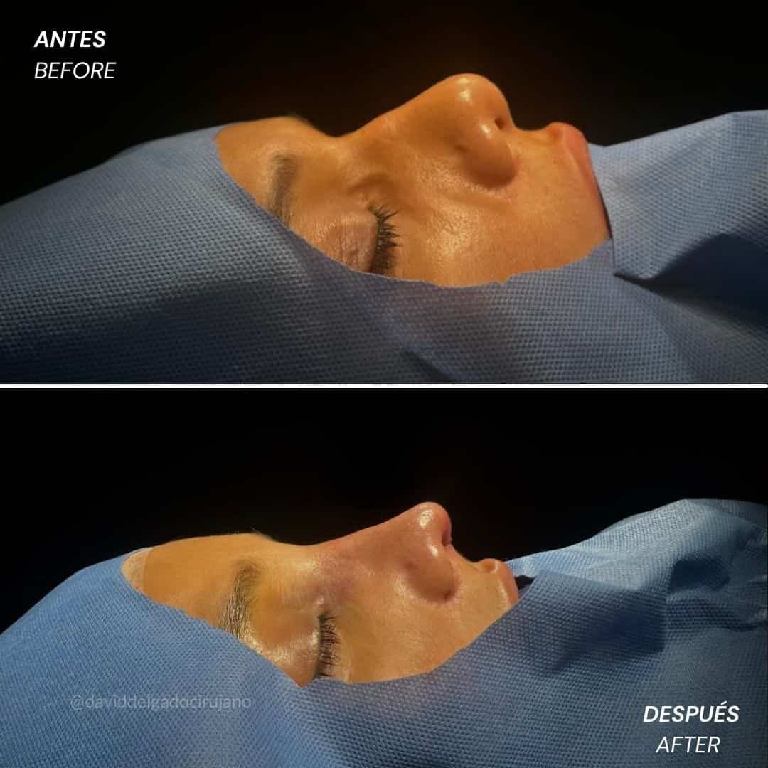 Before and After Rhinoplasty - Rinoplastia ultrasónica en Medellín - caso de antes y después - Dr. David Delgado - Cirujano Plástico en Medellín