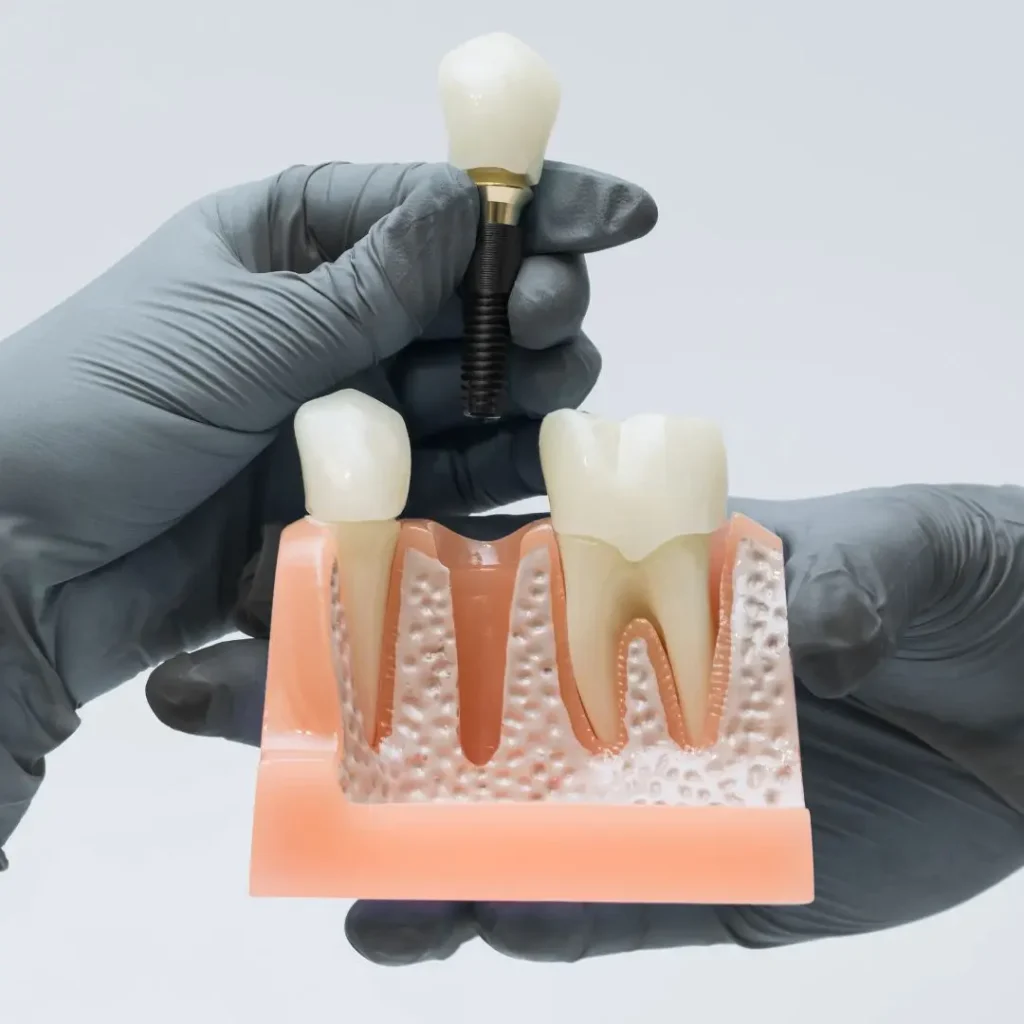 Dental implants in Colombia - Be Dharma Dental dentistry clinic in Medellín