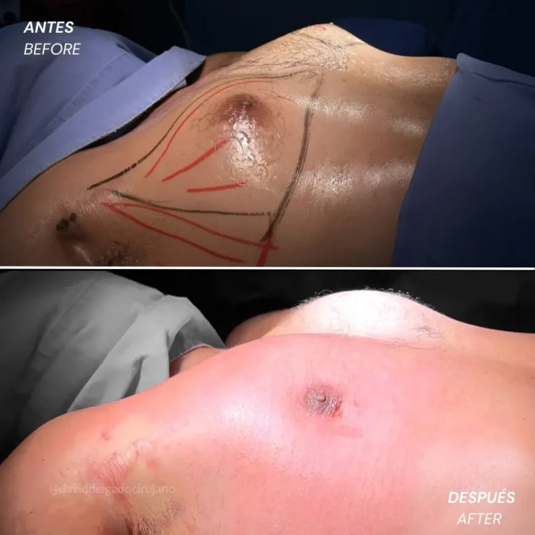 Gynecomastia before and after with Medellín plastic surgeon David Delgado - 060426