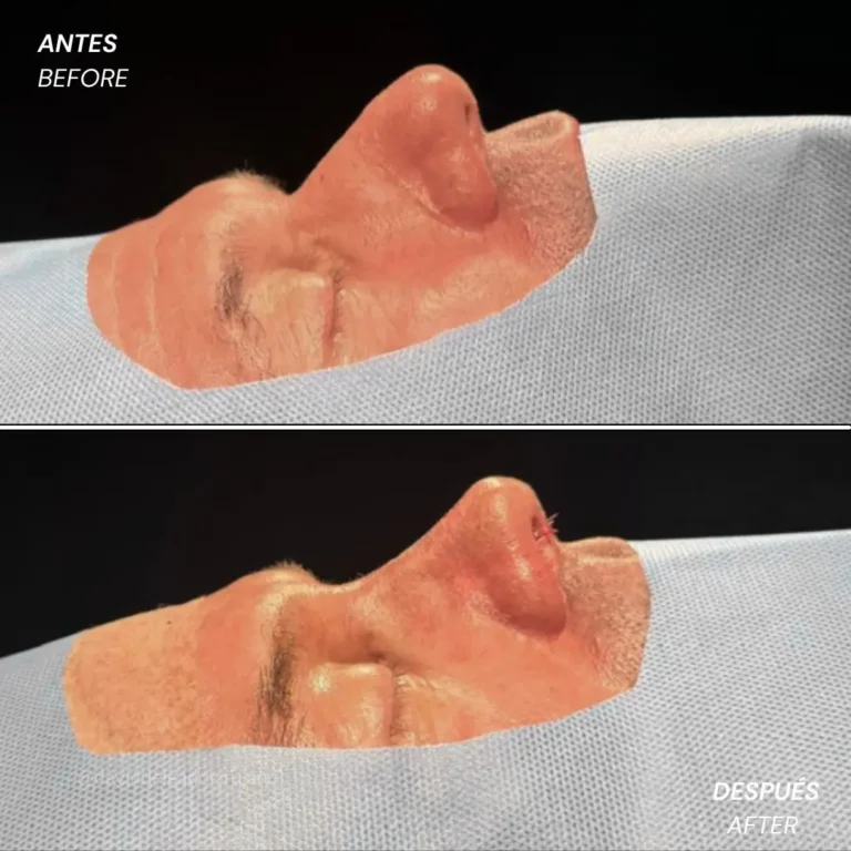 Rhinoplasty before and after with Medellín plastic surgeon David Delgado - 060426 2