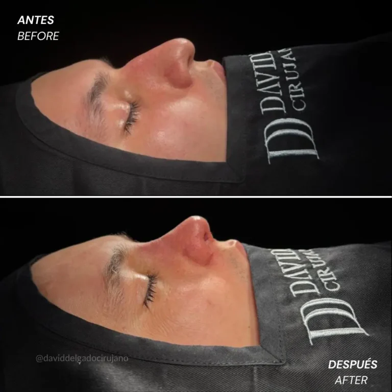 Rhinoplasty before and after with Medellín plastic surgeon David Delgado - 060426 3