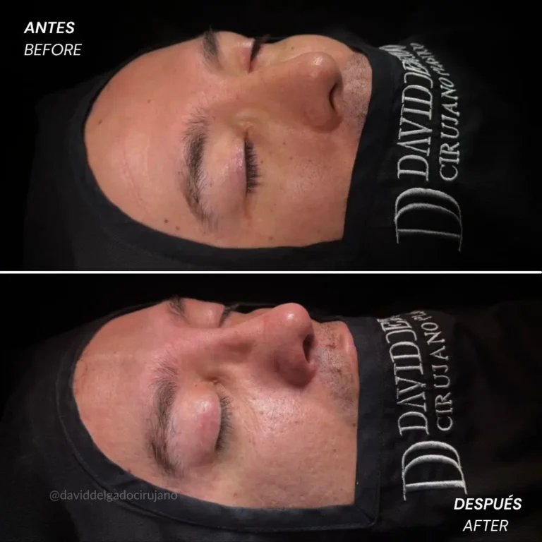 Rhinoplasty before and after with Medellín plastic surgeon David Delgado - 060426 4