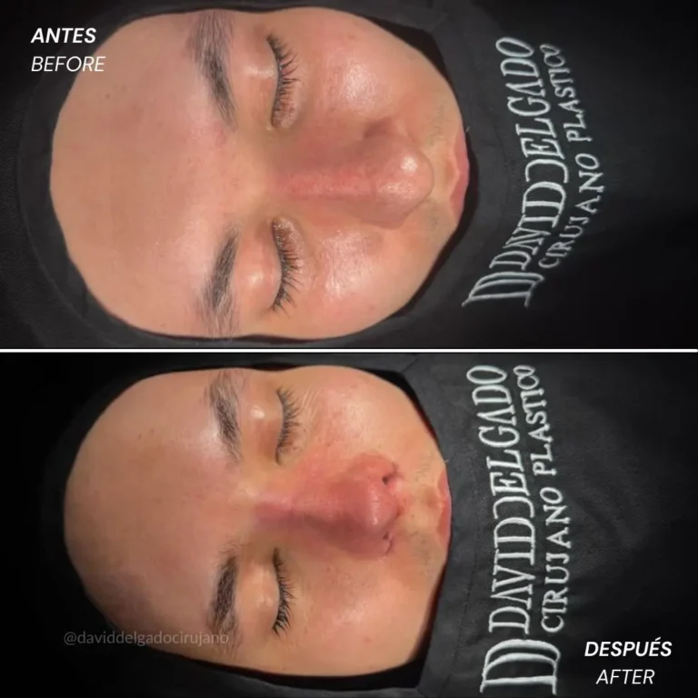 Rhinoplasty before and after with Medellín plastic surgeon David Delgado - 060426 5