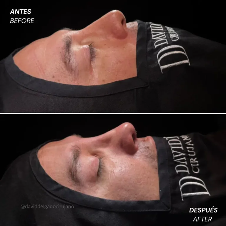 Rhinoplasty before and after with Medellín plastic surgeon David Delgado - 060426 6