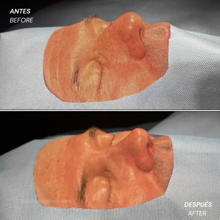 Rhinoplasty before and after with Medellín plastic surgeon David Delgado - 060426