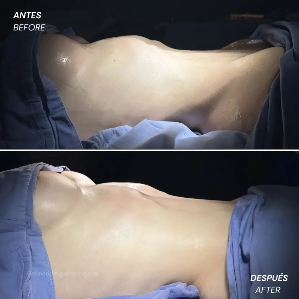 Rib remodeling before and after photo - Plastic surgeon in Colombia David Delgado