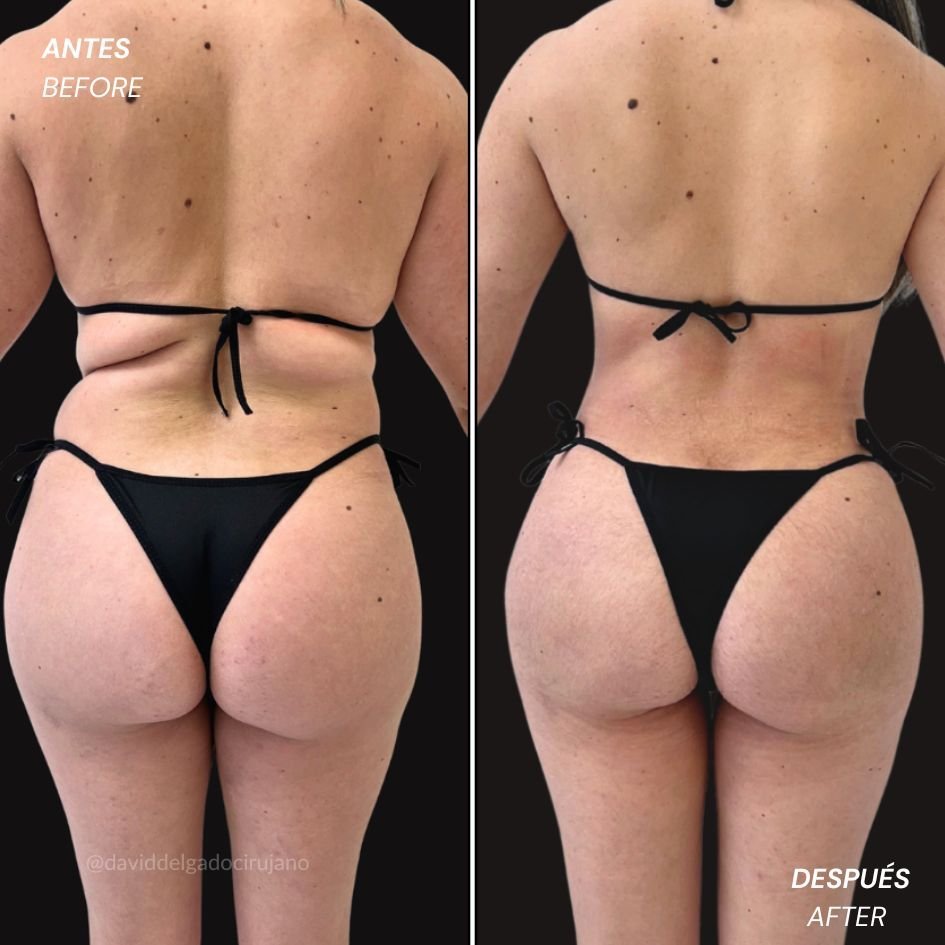 Female liposculpture before and after, waist and body definition result by Dr. David Delgado in Colombia