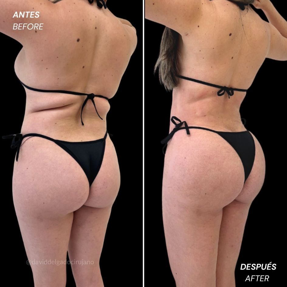 Female liposculpture before and after, waist and body definition result by Dr. David Delgado in Colombia