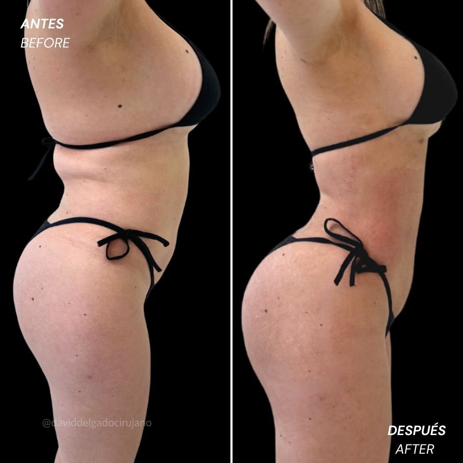 Female liposculpture before and after case 4 — defined waist by Dr. David Delgado, Colombia