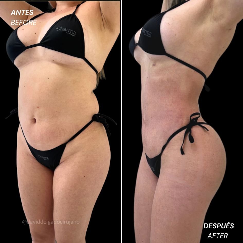 Female liposculpture before and after case 1 — defined waist by Dr. David Delgado, Colombia