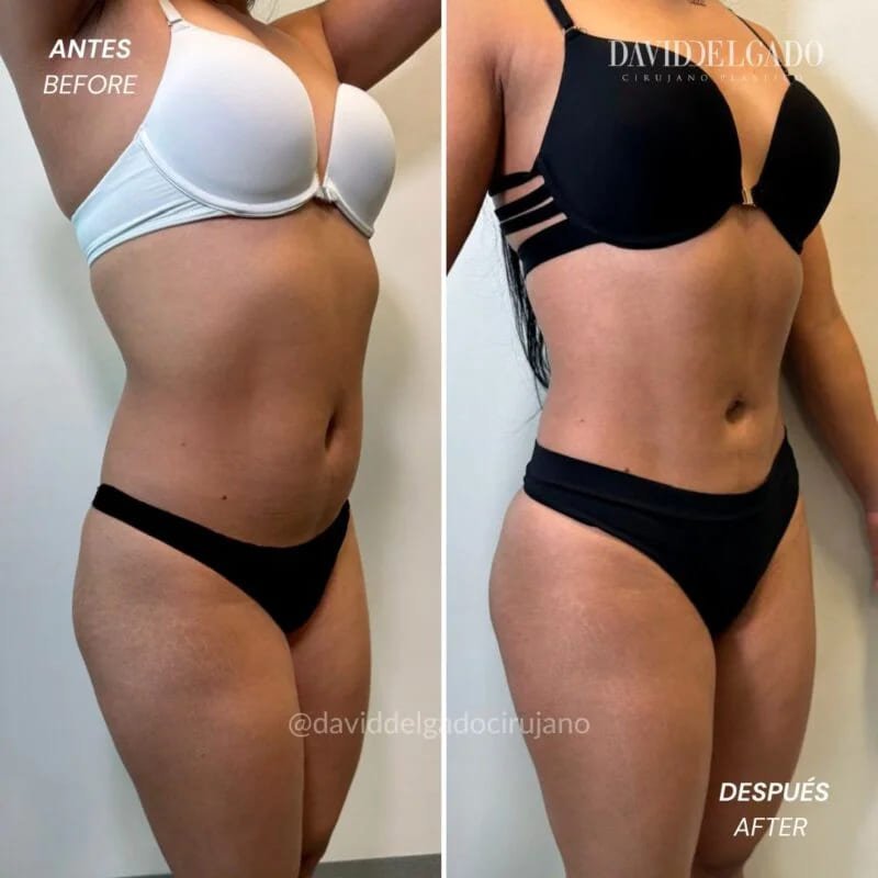 Lipo 360 before and after case 5 &mdash; Dr. David Delgado, Colombia