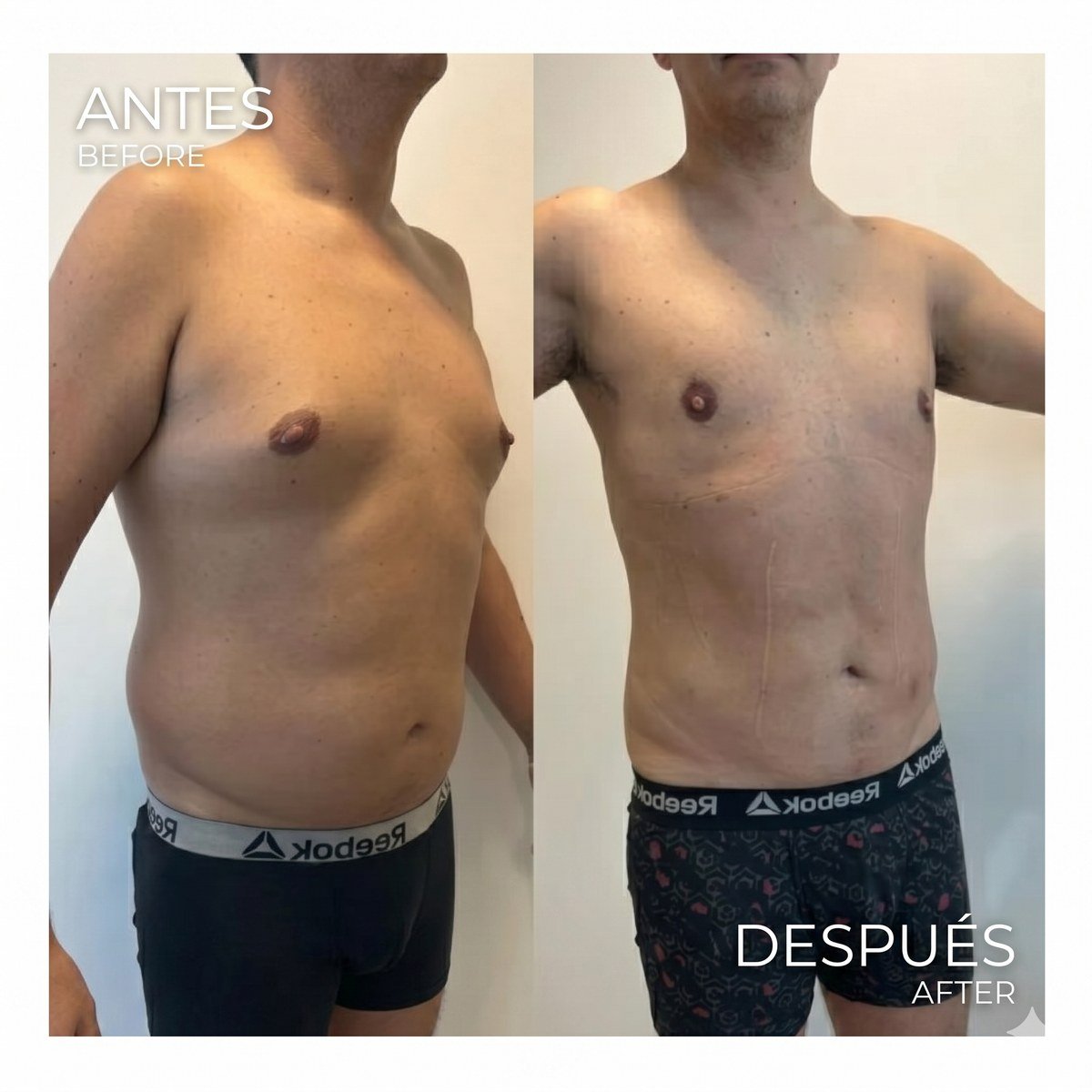 Lipo 360 before and after case 6 &mdash; Dr. David Delgado, Colombia