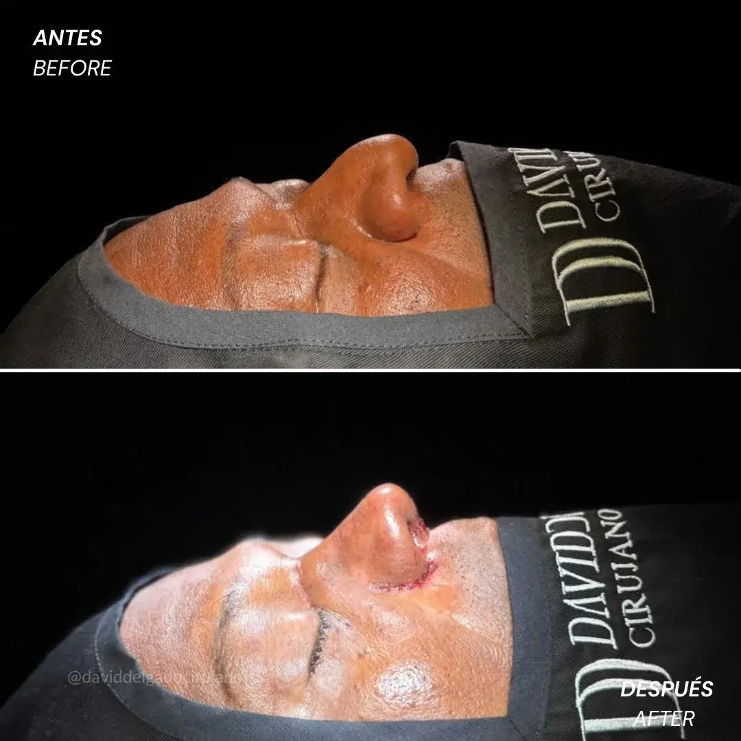 Ethnic rhinoplasty in Medellín- Dr. David Delgado - Before and after