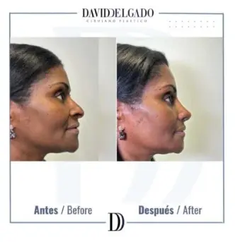 Ethnic rhinoplasty in Medellín- Dr. David Delgado - Before and after Women