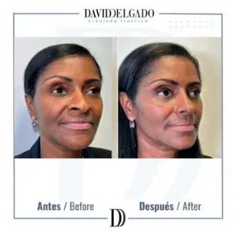 Ethnic rhinoplasty in Medellín- Dr. David Delgado - Before and after Women