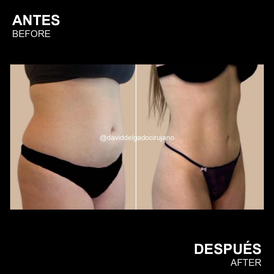 Female liposculpture before and after case 3 — defined waist by Dr. David Delgado, Colombia