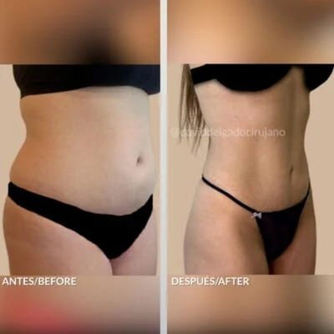 Mommy makeover before and after case 1 — Dr. David Delgado, Colombia