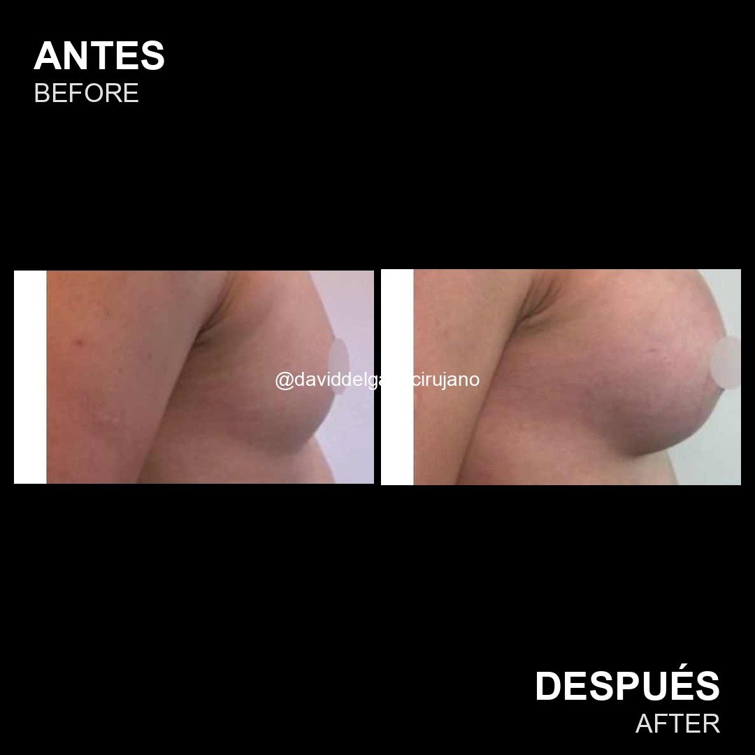 Mommy makeover before and after case 3 — Dr. David Delgado, Colombia