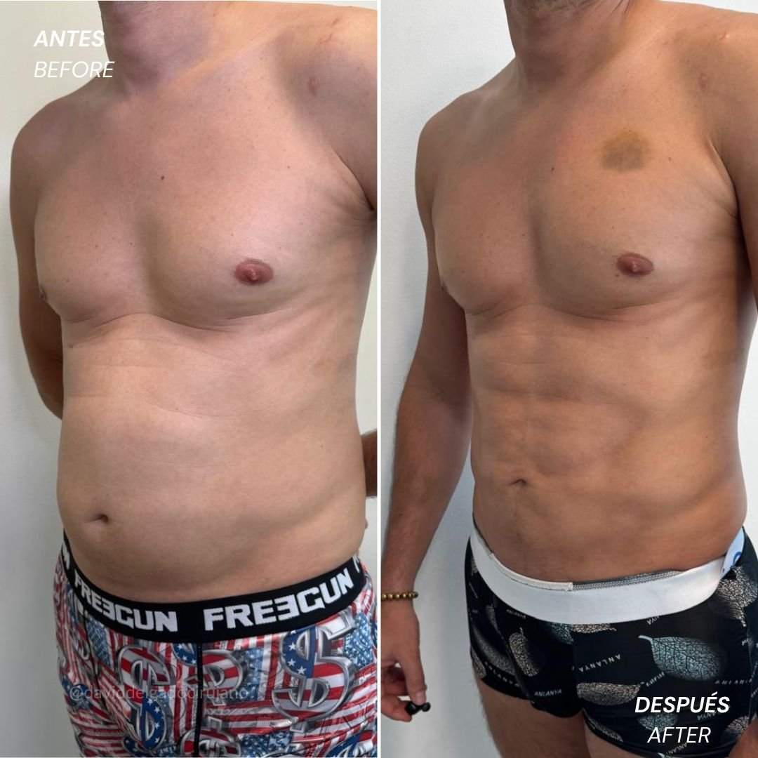 Abdominal etching before and after case 3 &mdash; Dr. David Delgado, Colombia
