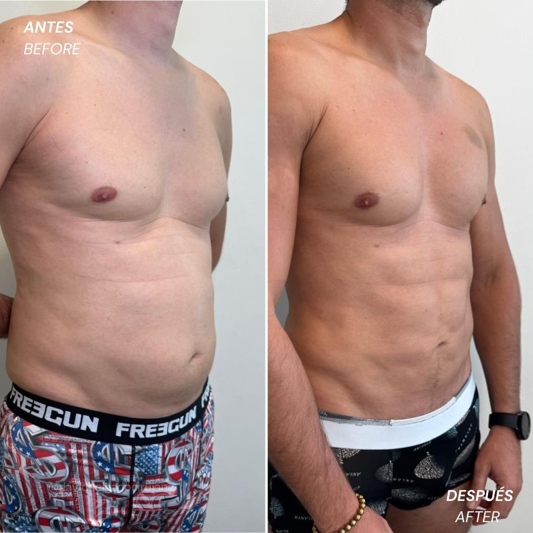 Abdominal etching before and after case 4 &mdash; Dr. David Delgado, Colombia