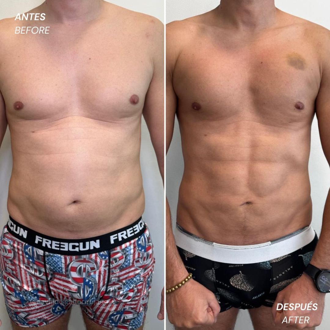 Abdominal etching before and after case 2 &mdash; Dr. David Delgado, Colombia